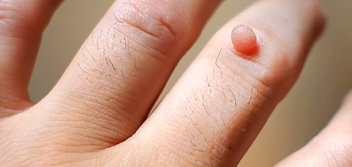 best-treatment-for-warts-in-bangalore-dr-joshy-s-medical-center