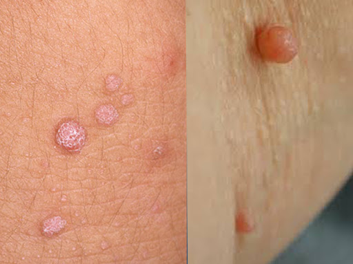 hpv warts skin tags private parts